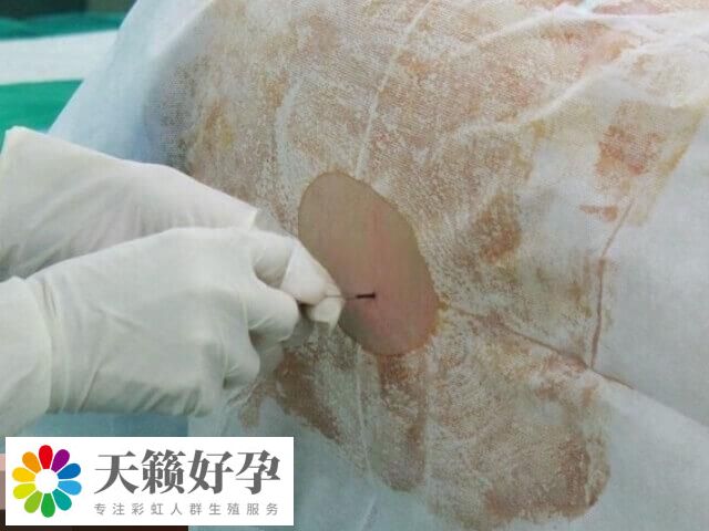 浅析试管婴儿为什么还要做宫腔镜，评估子宫环境为其一