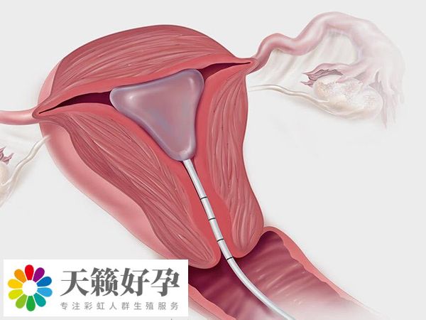 宫内探查能发现宫腔粘连