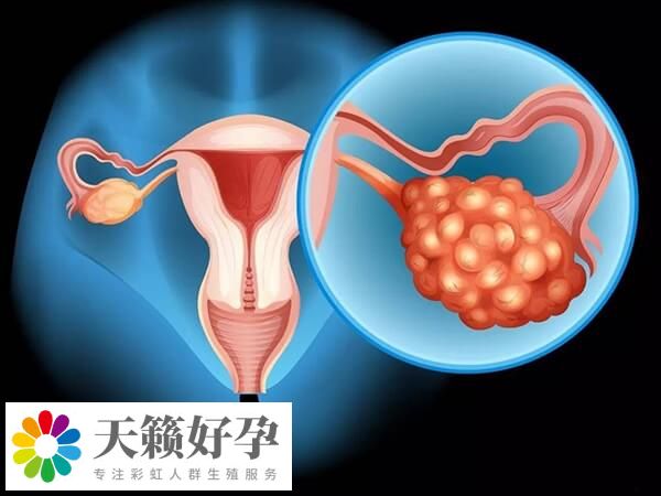 有卵巢刺激综合征不能移植鲜胚