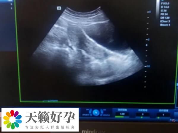 内膜形态异常一般不建议移植鲜胚