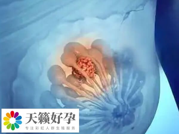 乳腺纤维瘤患者可以进行试管婴儿
