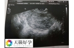 女性做人工授精失败转试管注意事项