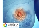 乳腺纤维瘤做试管会不会影响加重